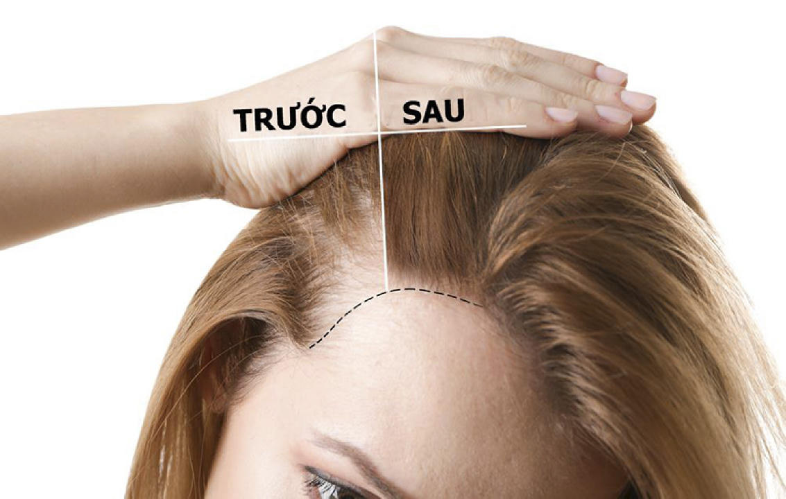 Các nhà khoa học khẳng định loại serum gốc thực vật NÀY là cách nhanh nhất để tóc mọc lại trong vài tuần; Đây là những gì chúng ta biết